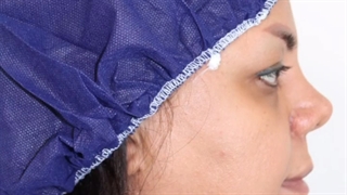 عمل بلفاروپلاستی و سانترال لب | دکتر علی الستی