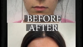 جراحی بینی گوشتی