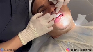 لمینت دندان در کلینیک دندانپزشکی نگین شیراز