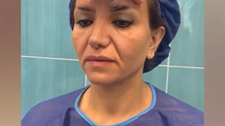 لیفت ابرو و صورت و گردن و کوتاهی پیشانی