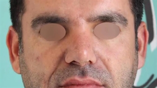 لیفت پیشانی به همراه جراحی بینی | دکتر علی الستی