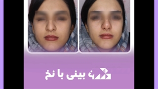 ماندگاری اصلاح فرم بینی با فیلر پیلینگ
