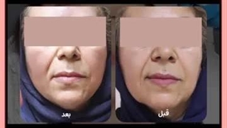 لیفت صورت طبیعی لیفت ابرو