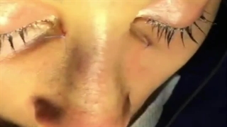 قبل و بعد از جراحی زیبایی بینی