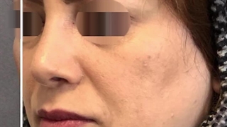 قبل و بعد از جراحی بینی