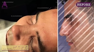 قبل و بعد از جراحی زیبایی بینی طبیعی و مردانه