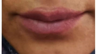 حذف تاتو لب با لیزر