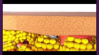 گونه گذاری لیزر مو