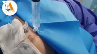 میدونید شانه یخ زده چطور درمان میشه؟