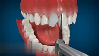 انیمیشن کامپوزیت دندان