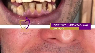 درمان ترکیبی روکش و لمینیت سرامیکی
