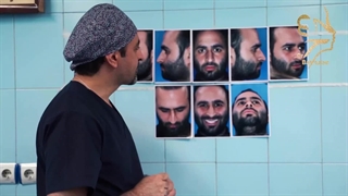 جراحی بینی با انحراف شدید(بخش دوم)