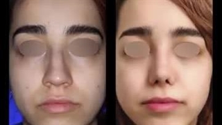 رینوپلاستی طبیعی بلافاصله بعد از عمل