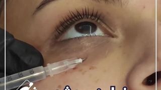 فیلر چشم در مرکز زیبایی شادمهر