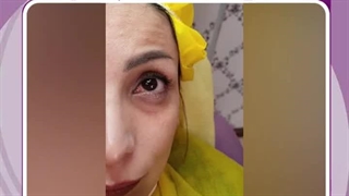 رفع گودی زیر چشم