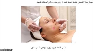 تکنیک جوانسازی با نخ های مونو