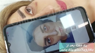 بهترین کلینیک زیبایی بلفاروپلاستی پلک پایین