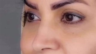 تغییر فوق العاده ایشون با تزریق چربی و‌کاشت ابرو
