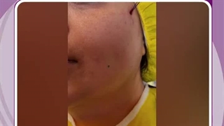 لیفت صورت با نخ