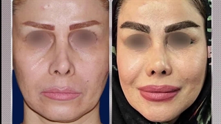 5سال پس از عمل ترمیم بینی و لیفت اندوسکوپی ابروها