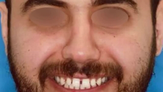 بستن فاصله بین دندان ها با ارتودنسی