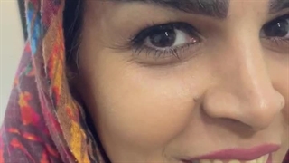 رضایت کاشت ابرو بعد از ۱۴ روز در مرکز کاشت ابرو کرج و در مرکز کاشت ابرو تهران