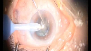 فیلم جراحی آب مروارید چشم (کاتاراکت).     dr.mina.mousavinezhad در اینستاگرام همراه ما باشید