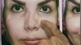 جراحی ترمیمی بینی با فرورفتگی و کجی شدید