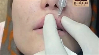 تزریق ژل پیروزی