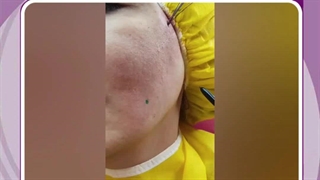 لیفت صورت با نخ