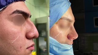 عمل زیبایی بینی ( رینوپلاستی )