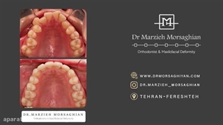 ارتودنسی نامرئی یا شفاف (invisible orthodontics)