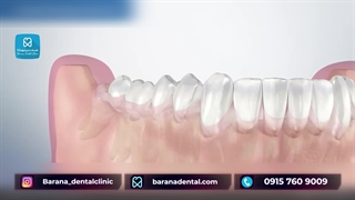 جراحی دندان عقل نهفته