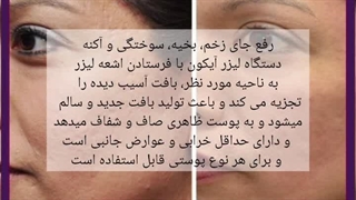 لیزر جوانسازی آیکون اکستنشن تاج دندان