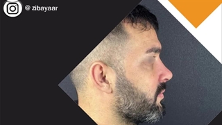 هزینه رینوپلاستی در مشهد