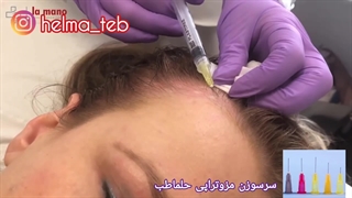 کاربردهای مزوتراپی