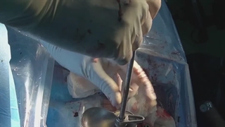 جراحی آندوسکوپی دیسک گردن و پشت