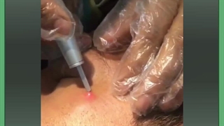 از بین بردن خال صورت در یک روز برداشتن توده