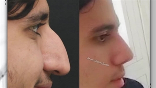 25 روز پس از جراحی بینی با قوز و افتادگی بسیار شدید