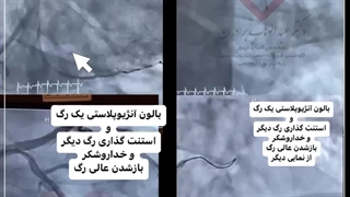 آنژیوپلاستی پیچیده بیمار جوان از طریق رگ دست