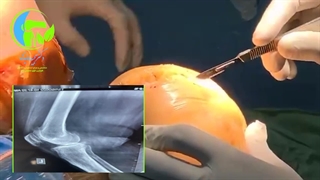 عمل جراحی آرتروز زانو 1