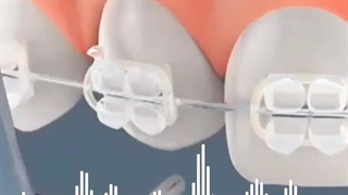 درمان جای خالی دندان با ارتودنسی