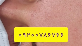 پانسمان ریمو تاتو