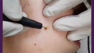 دستگاه خال برداری rf