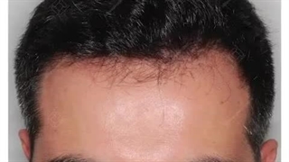 پیوند مو