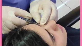 فیلر بینی برای چه کسانی مناسب است؟ میکرونیدلینگ