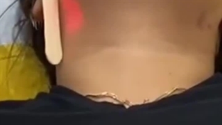 لیزر صورت خانم ها