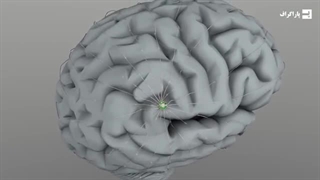 چیپ مغزی نورالینک تایید شد، درمان ناممکن‌ها