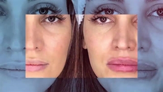 تفاوت فیلر لب روسی با فیلر لب معمولی لیزر مو