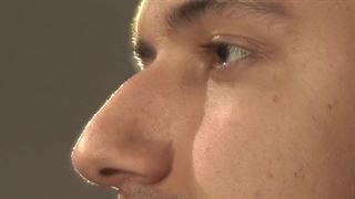 جراحی بینی قوزدار با افتادگی نوک بینی